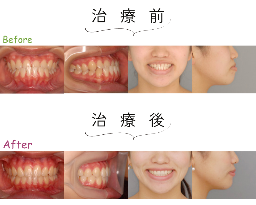 歯列矯正で横顔は変わる？Eラインが整う理由と実際の症例を紹介