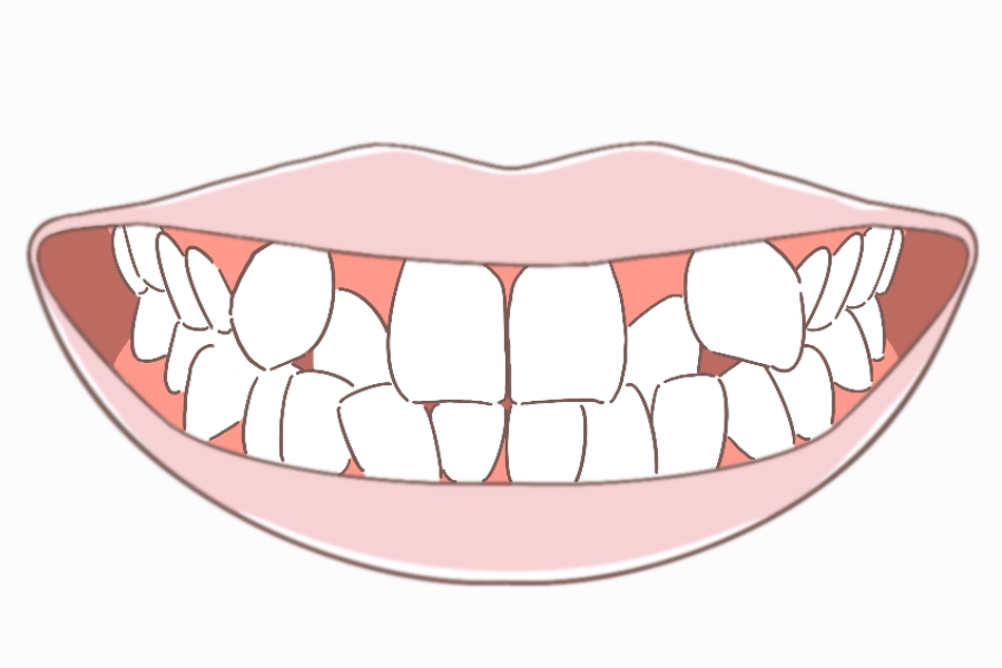 ガタガタ歯/八重歯