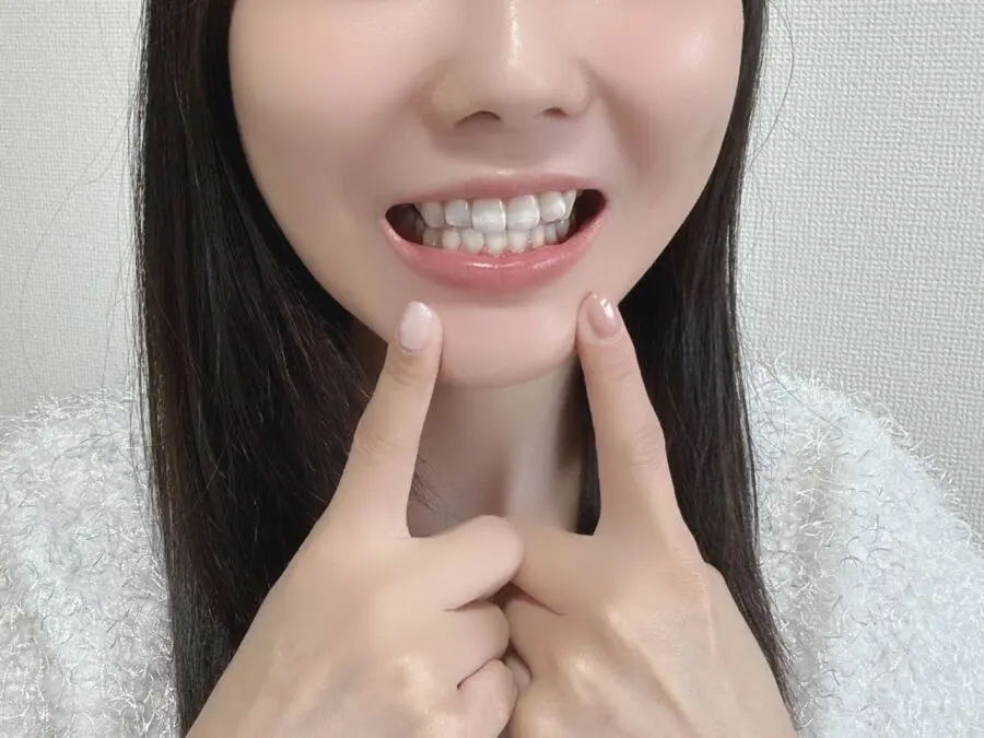 矯正治療中の一時的な顔の変化
