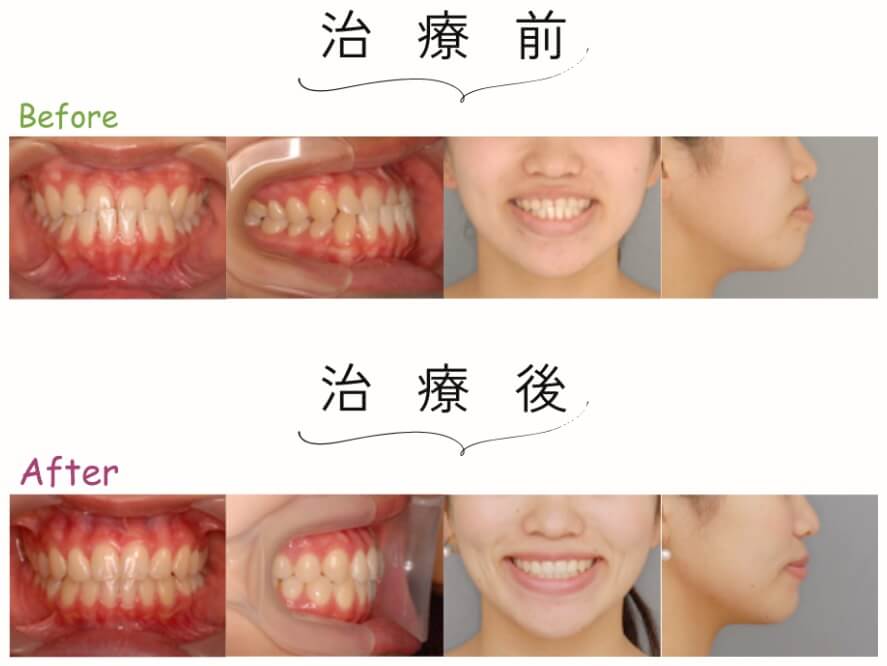 症例:受け口の矯正
