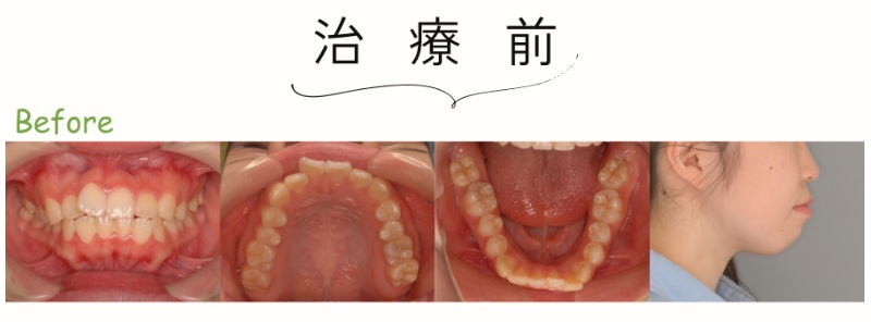 治療前：口ゴボ症例