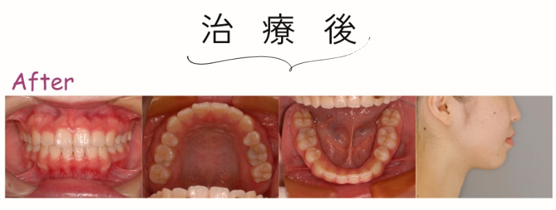 治療後：口ゴボ症例