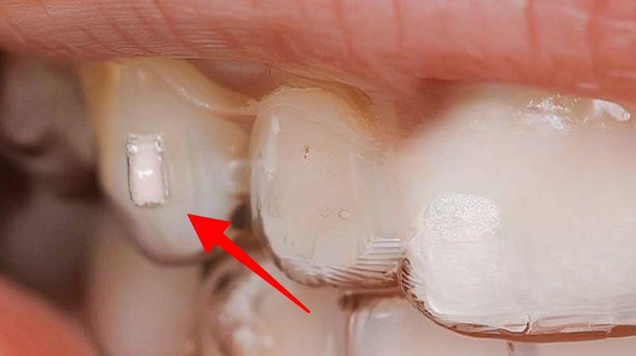 インビザラインのアタッチメント