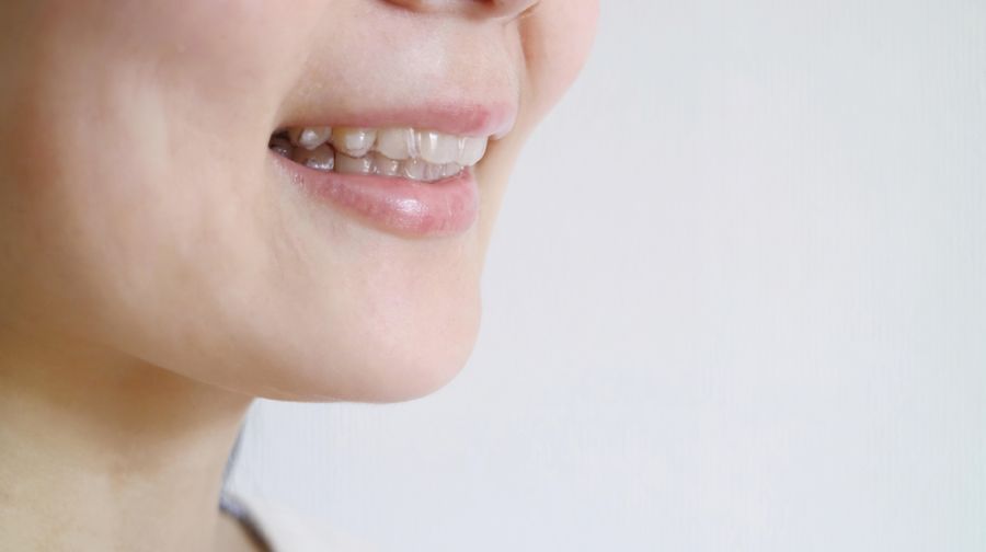 インビザラインアタッチメントのトラブル