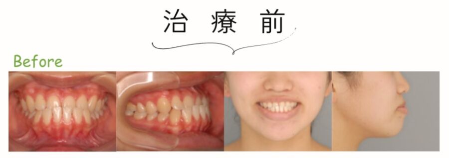 治療前:受け口の裏側矯正