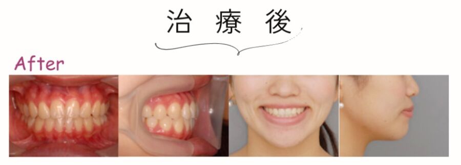 治療後:受け口の裏側矯正